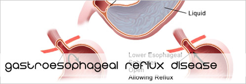 Homeopathic Medicines for Gastroesophageal Reflux Disease ...
