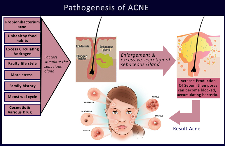 pathogenesis of acne