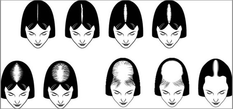 Homeopathy treatment for alopecia